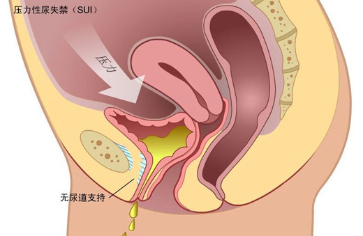 盆底康复之慢肌、快肌训练篇